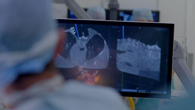 Image of intraoperative neuromonitoring during scoliosis surgery